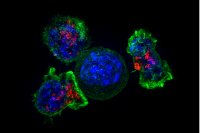 killer t cells surrounding a cancer cell